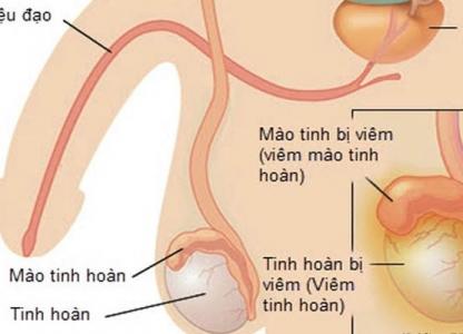 viem-tinh-hoan