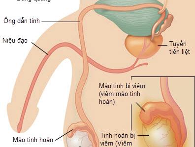 viem-ong-dan-tinh-nguyen-nhan-va-cach-dieu-tri