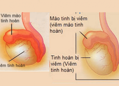 chua-viem-tinh-hoan-hieu-qua-lay-lai-ban-linh-dan-ong-va-ngan-ngua-vo-sinh-cho-phai-manh