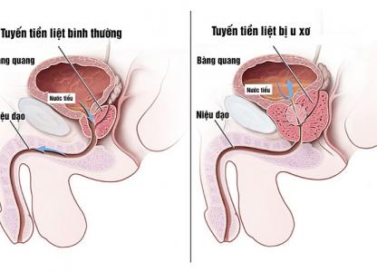 u-xo-tien-liet-tuyen-la-gi-co-nguy-hiem-khong-dieu-tri-nhu-the-nao