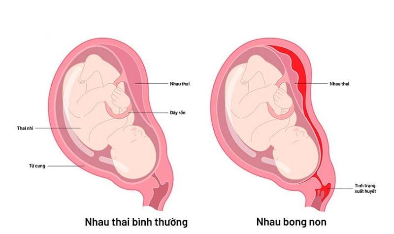 đau bụng dưới khi mang thai 6