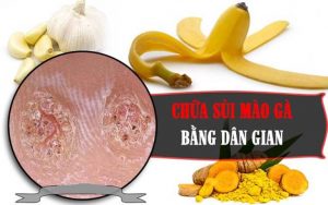 5 cách chữa bệnh sùi mào gà bằng thuốc nam tại nhà đơn giản