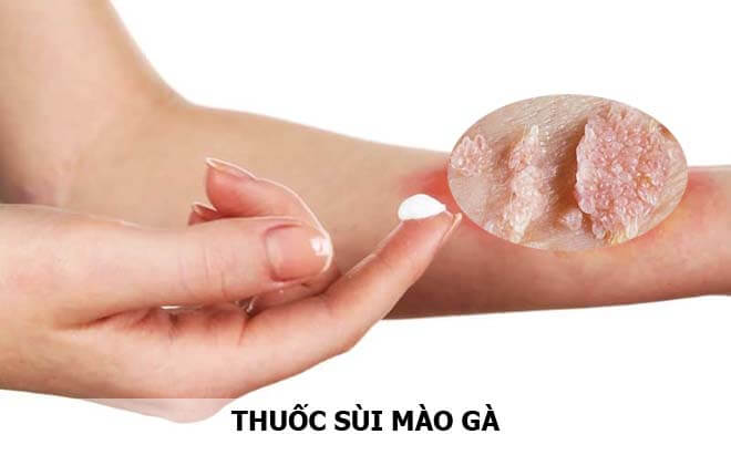 Top 4 loại thuốc chữa sùi mào gà phổ biến nhất hiện nay