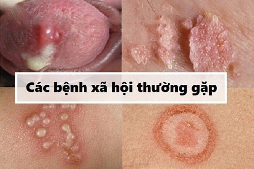 bệnh xã hội ở nữ giới